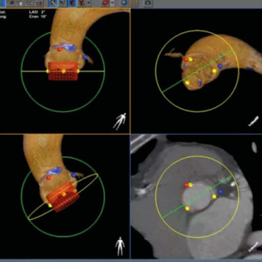 TAVI-CT - Internistisches Klinikum Mnchen Sd